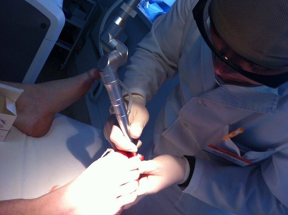 Mykosiaren laser tratamendua